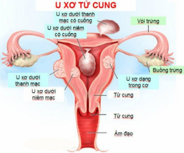 u-xo-tu-cung1.jpg