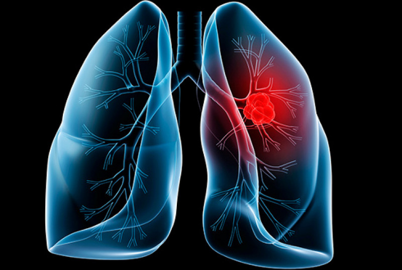 lungcancer.jpg