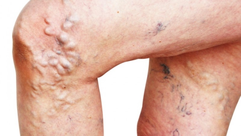 varicose-veins.jpg