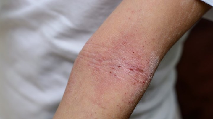 4_hives_rash_or_eczema_1502123302_zjgp.jpg