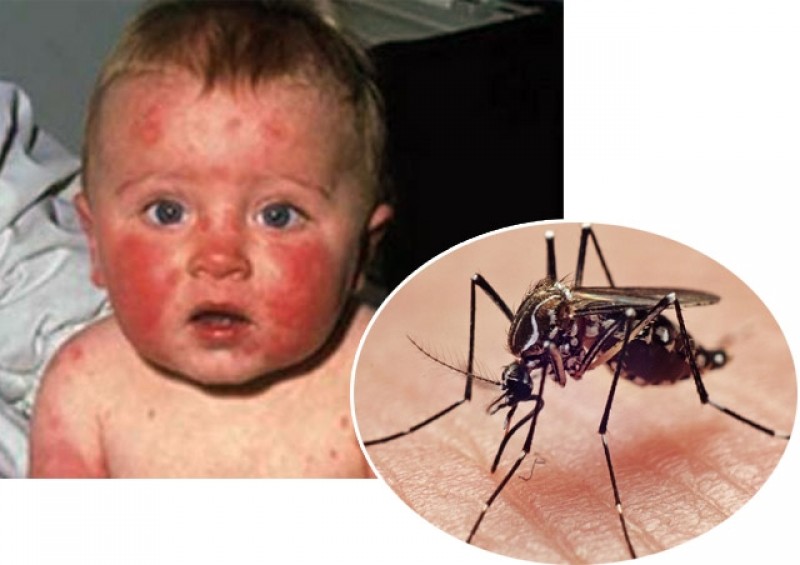 virus-zika2-1511.jpg