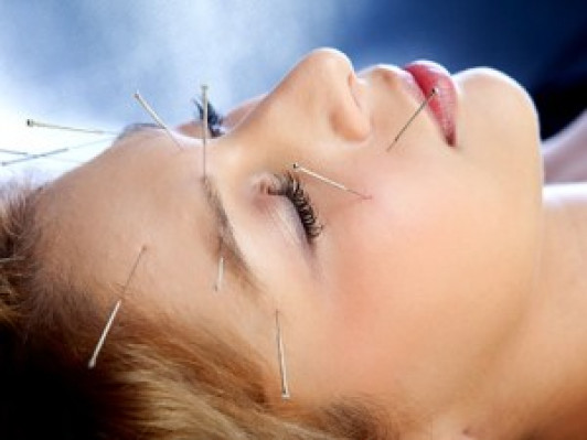 headache-acupuncture.jpg