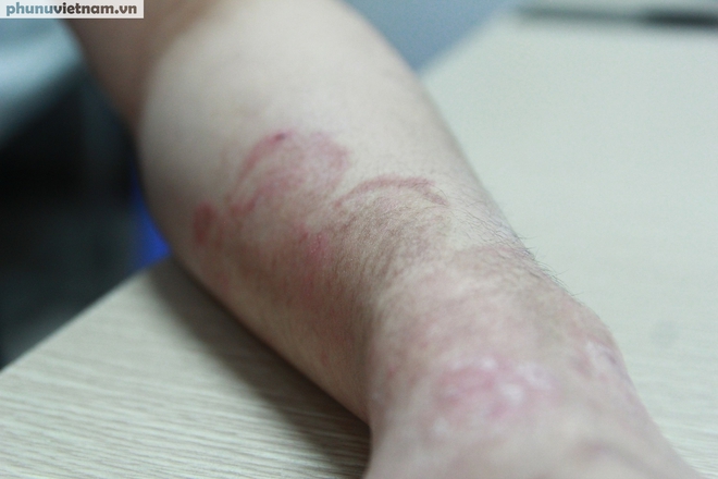 Thời tiết nồm ẩm, nhiều người “khốn khổ” vì bệnh da liễu- Ảnh 2.