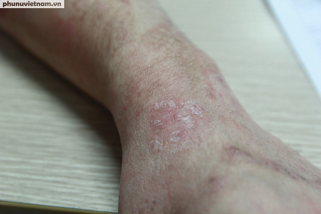 Thời tiết nồm ẩm, nhiều người “khốn khổ” vì bệnh da liễu- Ảnh 3.