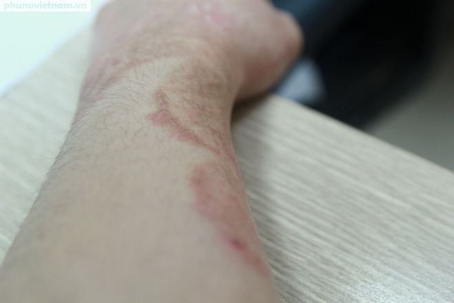 Thời tiết nồm ẩm, nhiều người “khốn khổ” vì bệnh da liễu- Ảnh 4.