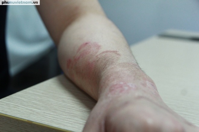 Thời tiết nồm ẩm, nhiều người “khốn khổ” vì bệnh da liễu- Ảnh 5.