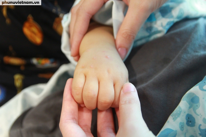 Trẻ giật mình khi bị tay chân miệng, cha mẹ cần lập tức đưa con đến bệnh viện- Ảnh 3.