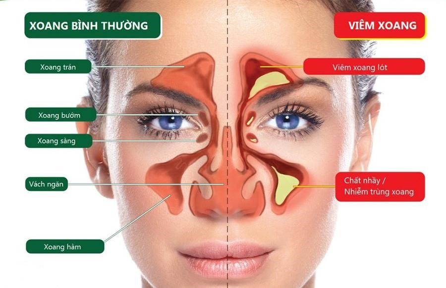 Làm thế nào để điều trị viêm xoang mạn tính? - Ảnh 2.