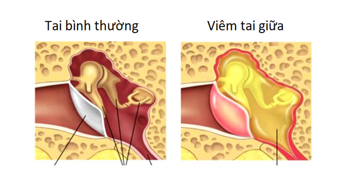 Viêm tai giữa là một biến chứng của viêm xoang mạn tính thường gặp (Ảnh: Internet)