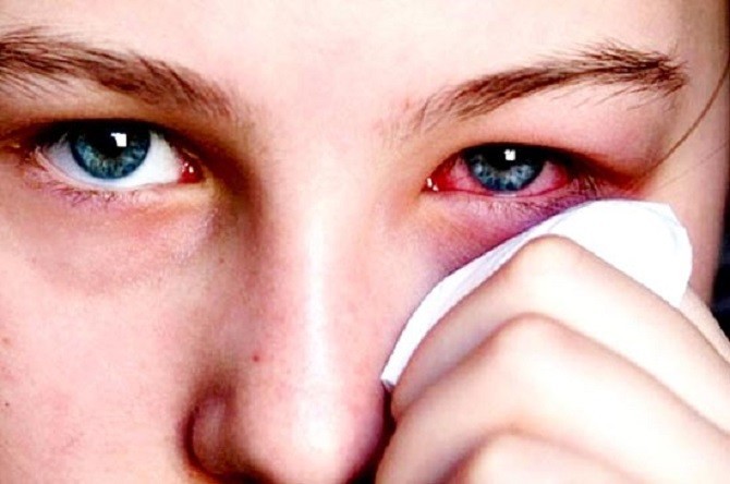 Các vấn đề nhiễm trùng mắt thường gặp trong mùa mưa cần biết - Ảnh 2.