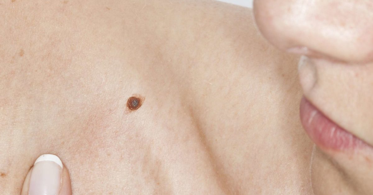 Nốt ruồi cảnh báo ung thư: Phân biệt nốt ruồi ung thư và nốt ruồi thường - Ảnh 3.