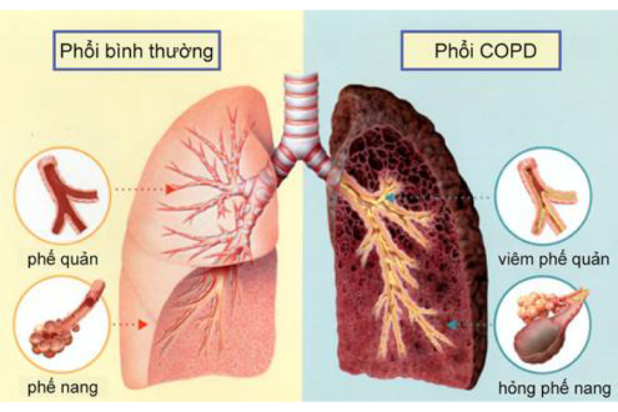 Các biện pháp làm giảm triệu chứng phổi tắc nghẽn mãn tính tại nhà - Ảnh 1.