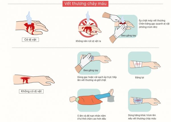 Vết thương hở: Sai lầm khi cầm máu và hướng dẫn cầm máu đúng cách khi bị thương - Ảnh 5.