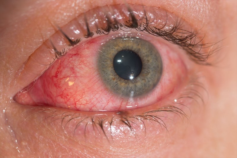 Viêm giác mạc - Nguy hiểm từ biến chứng của đau mắt đỏ ở trẻ em - Ảnh 2.