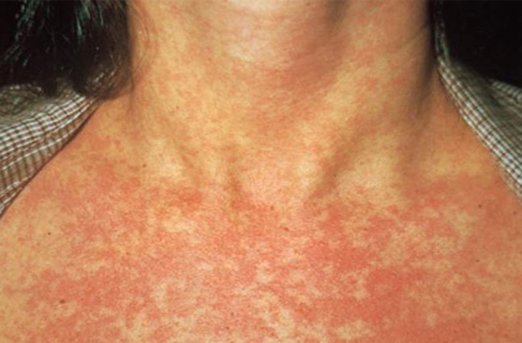 Cách phân biệt bệnh sởi và bệnh rubella - Ảnh 1.