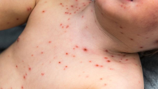 Dựa vào dấu hiệu bệnh sởi để phân biệt với sốt phát ban, Rubella và thuỷ đậu - Ảnh 4.