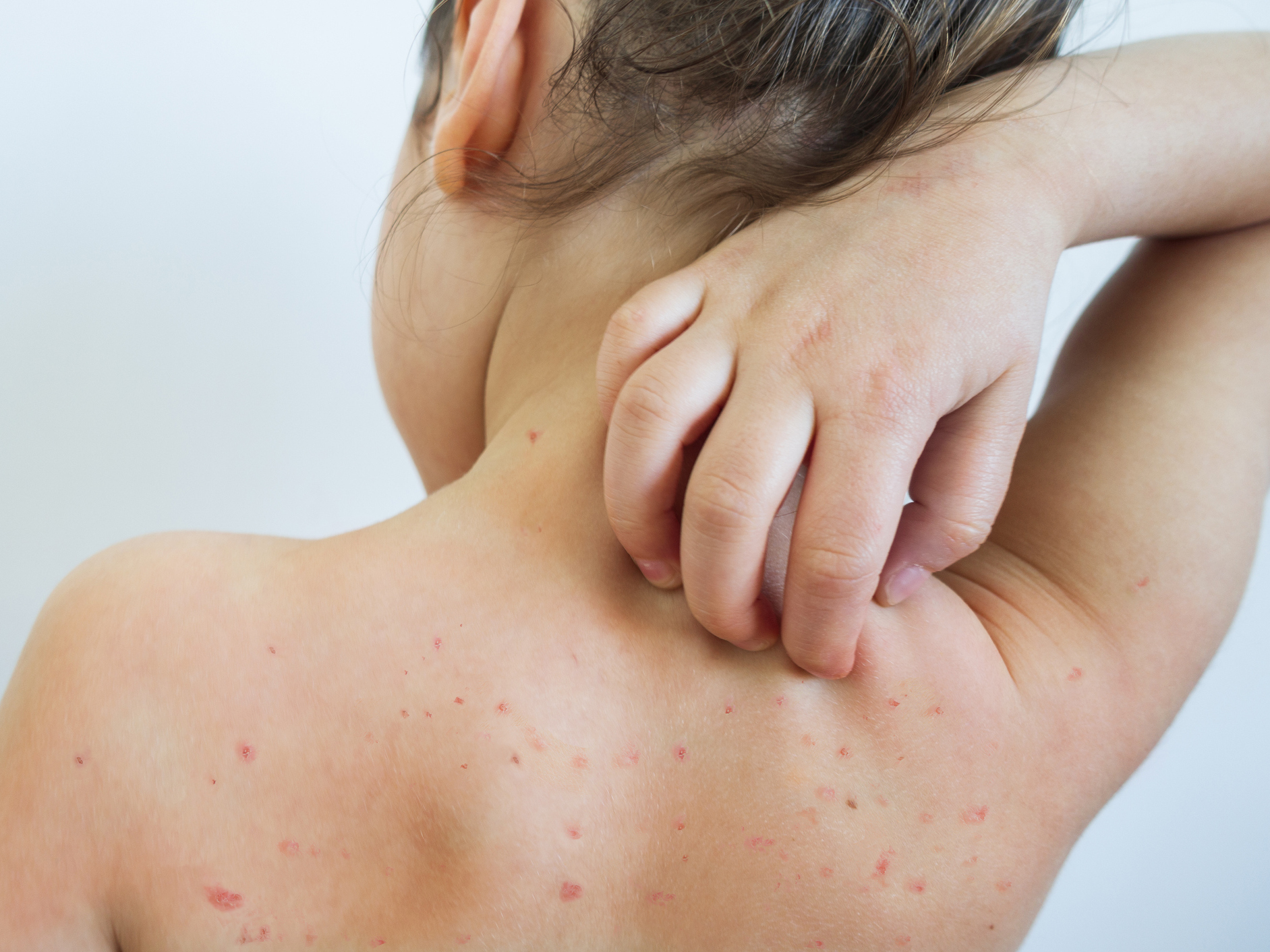 Dựa vào dấu hiệu bệnh sởi để phân biệt với sốt phát ban, Rubella và thuỷ đậu - Ảnh 3.