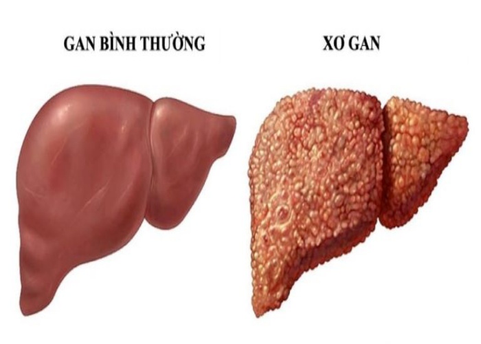 Hội chứng suy tế bào gan: Biểu hiện, tác hại và phương pháp điều trị  - Ảnh 1.