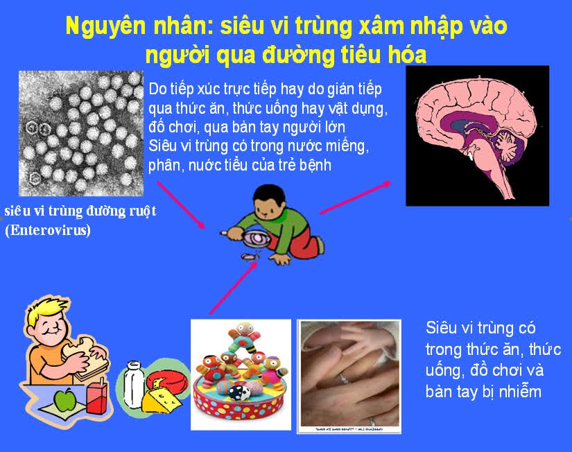 Nguyên nhân gây lây lan bệnh tay chân miệng (Ảnh: Internet)