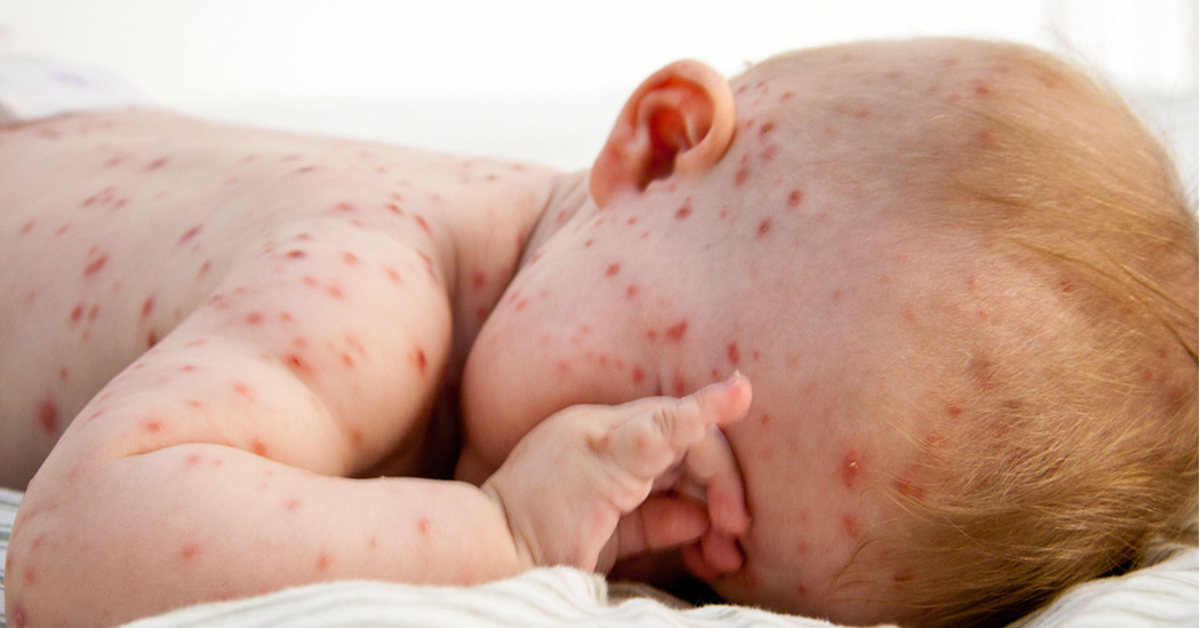 Tìm hiểu về Varicella Zoster Virus nguyên nhân chính gây ra bệnh thuỷ đậu - Ảnh 1.