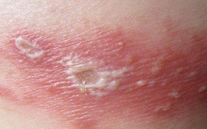 Có hay không nguy cơ tái phát bệnh thủy đậu? Dấu hiệu nào cho thấy Varicella Zoster Virus tấn công bạn lần 2? - Ảnh 2.