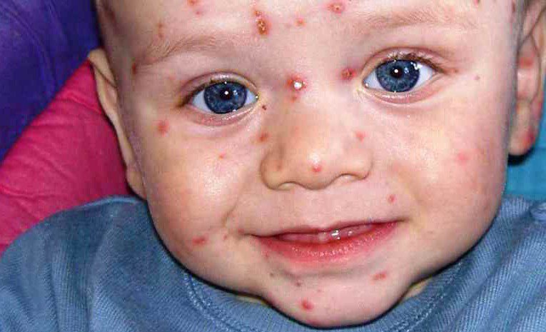 Tìm hiểu về Varicella Zoster Virus nguyên nhân chính gây ra bệnh thuỷ đậu - Ảnh 3.