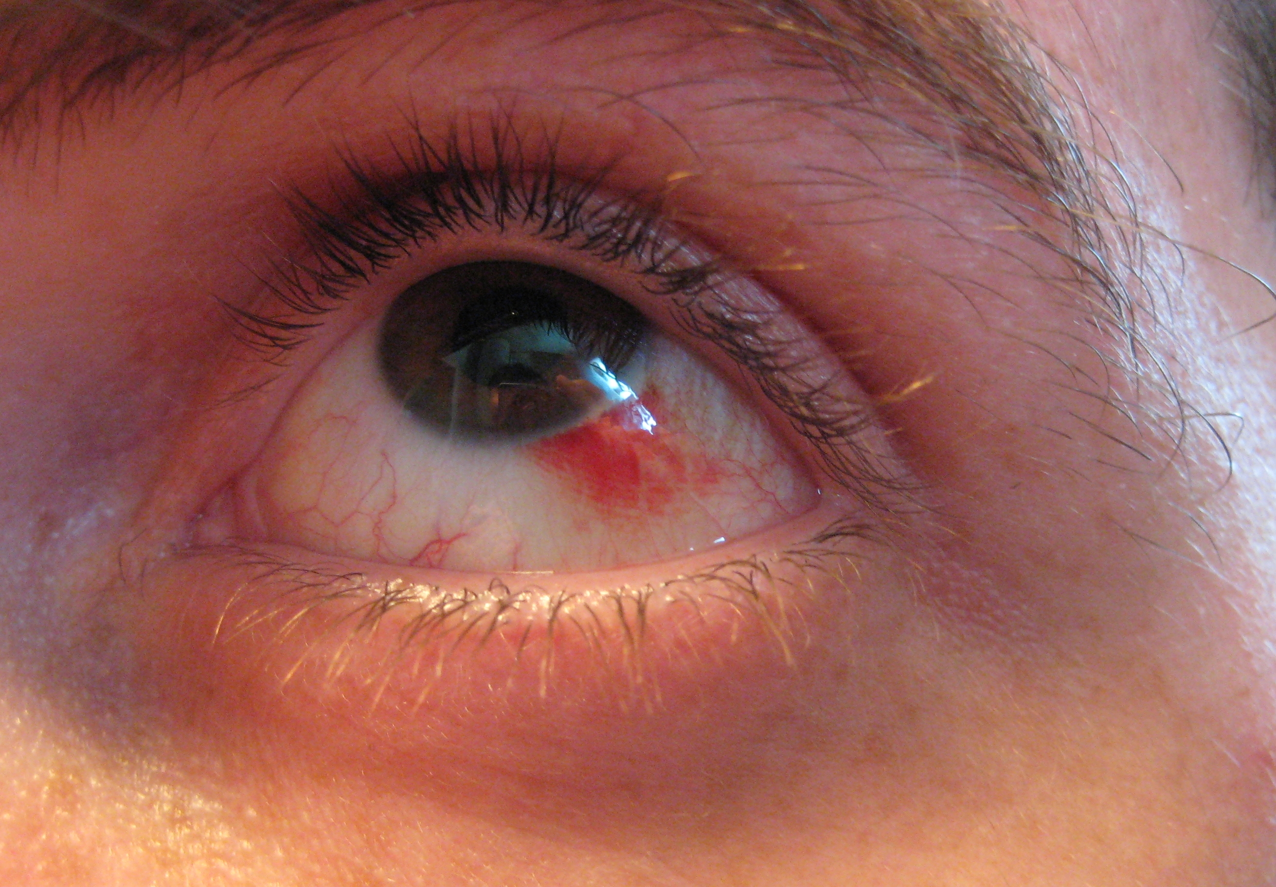 Đau mắt đỏ chảy máu có nguy hiểm không? - Ảnh 1.