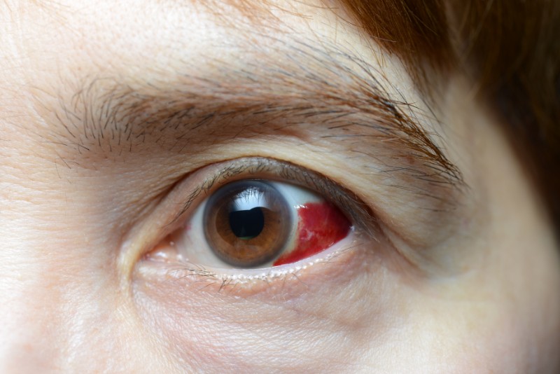 Đau mắt đỏ chảy máu có nguy hiểm không? - Ảnh 2.