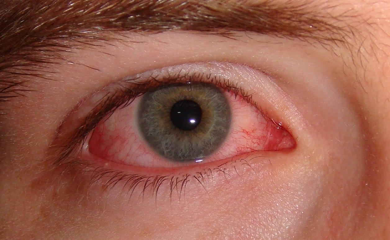 Đau mắt đỏ do kính áp tròng: Nguyên nhân, dấu hiệu nhận biết và cách điều trị - Ảnh 1.