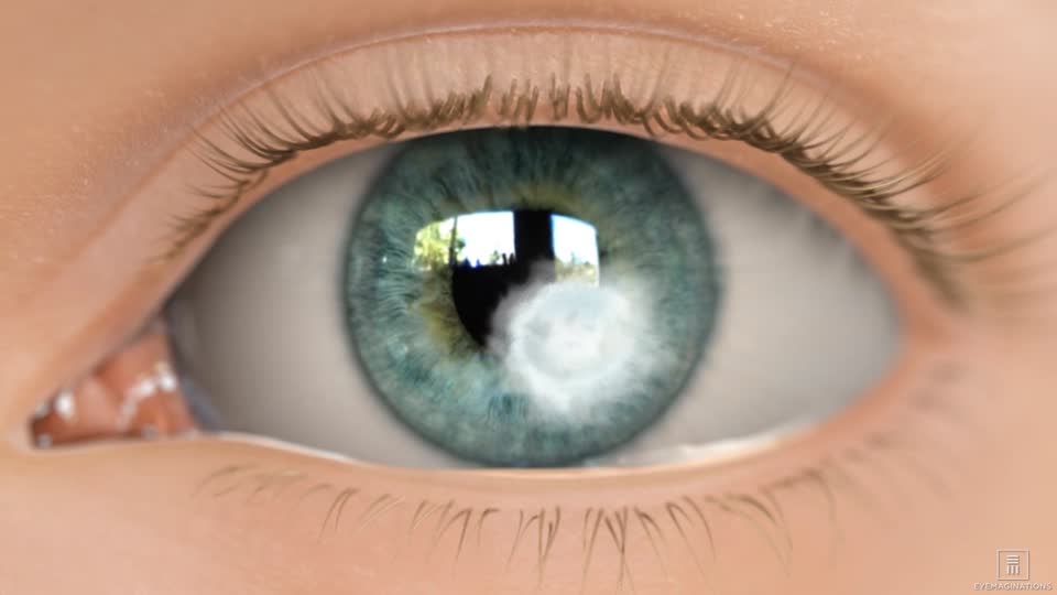 Đau mắt đỏ do kính áp tròng: Nguyên nhân, dấu hiệu nhận biết và cách điều trị - Ảnh 3.