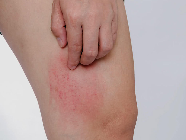 Sẩn ngứa mùa hè: Bệnh ngoài da thường gặp cần cảnh giác - Ảnh 3.