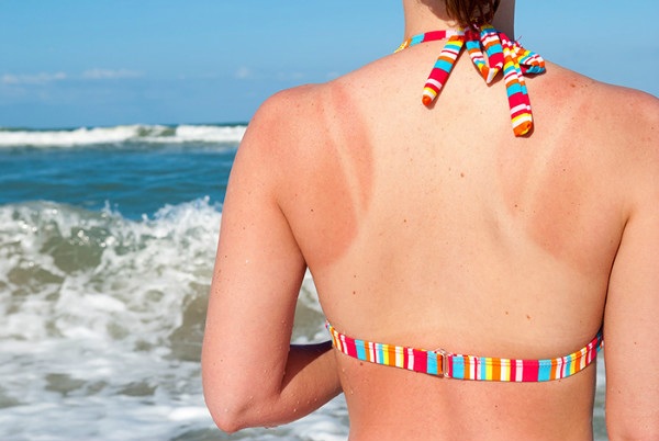 Áp dụng 5 cách chăm sóc da bị cháy nắng đơn giản giúp da lên tông nhanh chóng - Ảnh 1.