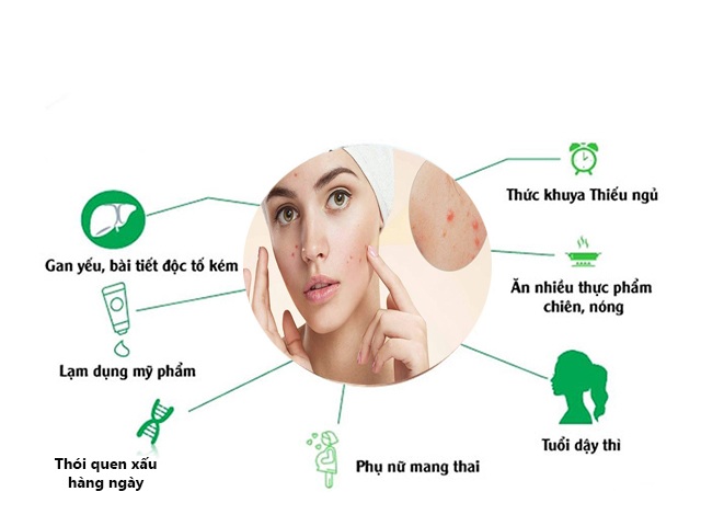 10 cách trị mụn ẩn dưới da tại nhà an toàn hiệu quả nhanh nhất - Ảnh 2.