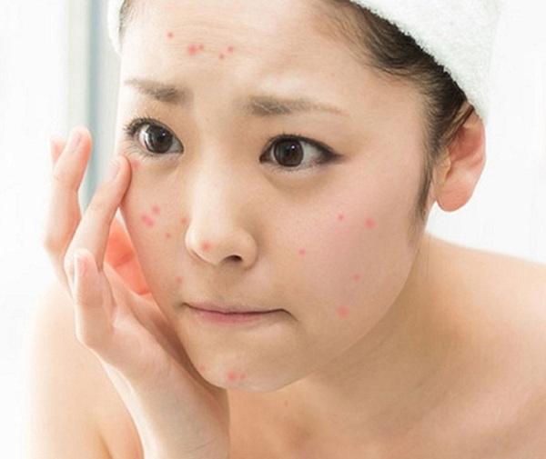 Nan giải đối mặt với loạt bệnh về da ngày hè, nhất là da đổ dầu, bóng nhờn - Ảnh 2.