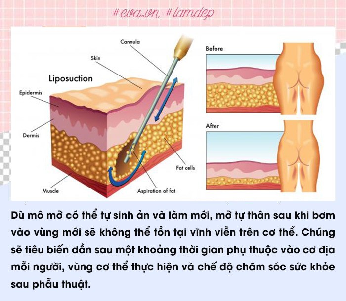 Để không gặp biến chứng, nàng lưu ngay các sai lầm phổ biến thường gặp khi cấy mỡ tự thân - Ảnh 4.