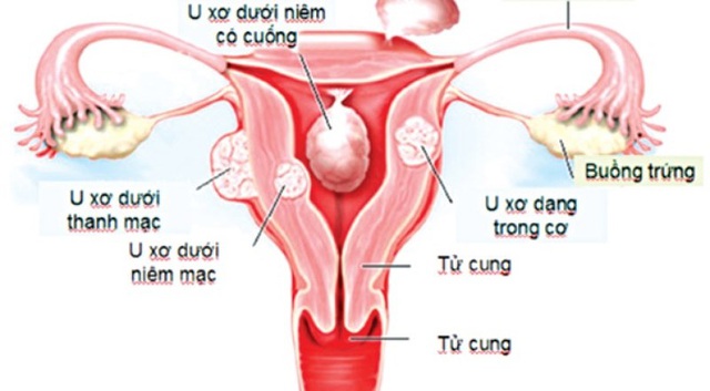 U xơ tử cung là nguyên nhân khiến thai chết lưu (hình minh họa)