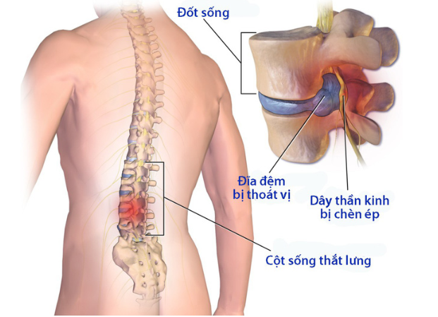 Tê đầu ngón tay thường xuyên, chớ nên chủ quan - Ảnh 3.