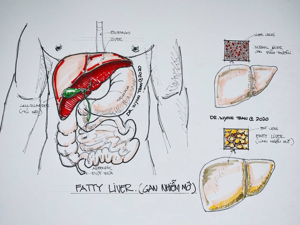 Vì sao gan của chúng ta bị nhiễm mỡ? - Ảnh 2.