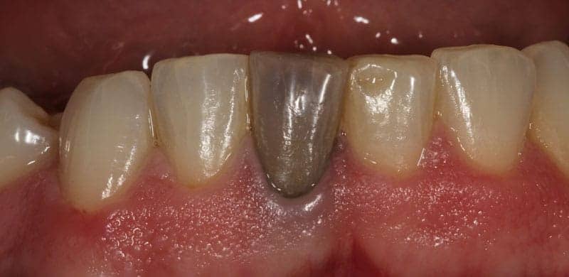 5 dấu hiệu răng bị chết tủy mà bạn cần biết - Ảnh 1.
