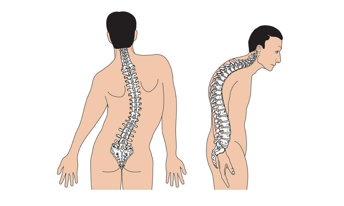 Nguyên nhân, cách chữa trị và phòng tránh gù lưng ở người già an toàn, hiệu quả - Ảnh 1.