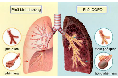 Bệnh phổi tắc nghẽn mạn tính (COPD) có thể chữa khỏi được không? - Ảnh 1.