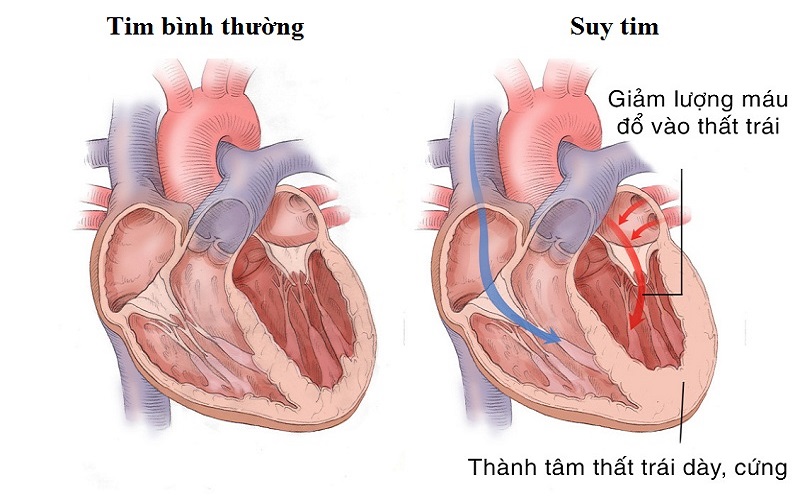 Bệnh to tim ở người già và những điều cần biết - Ảnh 4.