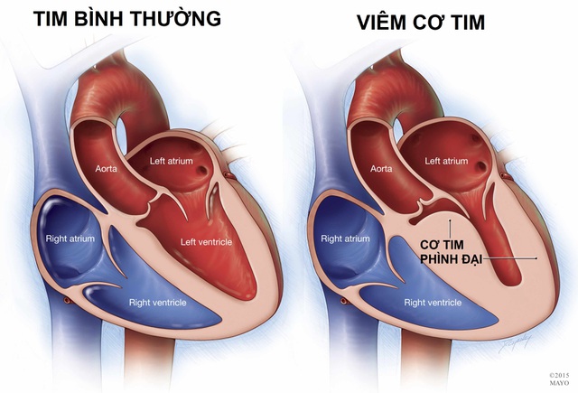 Bệnh to tim ở người già và những điều cần biết - Ảnh 3.