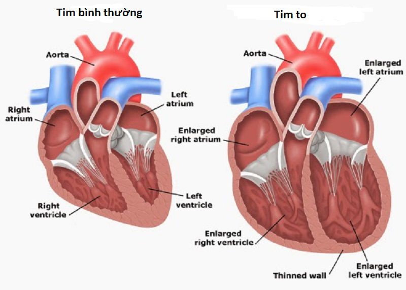 Bệnh to tim ở người già và những điều cần biết - Ảnh 2.