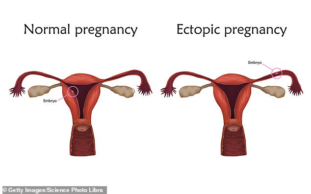 51884701-10317913-In_a_typical_ectopic_pregnancy_a_fertilized_egg_will_implant_in_-a-8_1639676688484.jpg