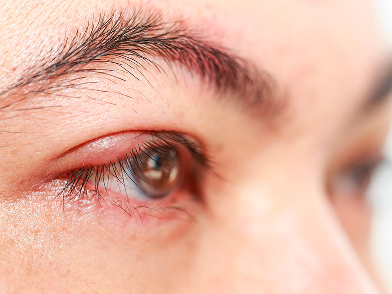 Điểm danh 5 bệnh về mắt mùa hè thường gặp - Ảnh 2.