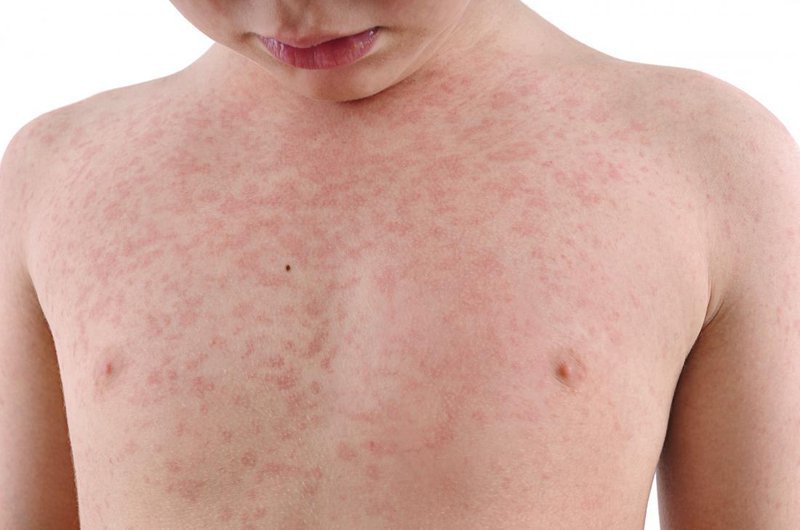 Những điều cần biết về quá trình điều trị bệnh Rubella - Ảnh 2.