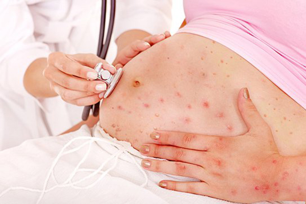 Điều trị bệnh Rubella và những điều cần biết - Ảnh 3.