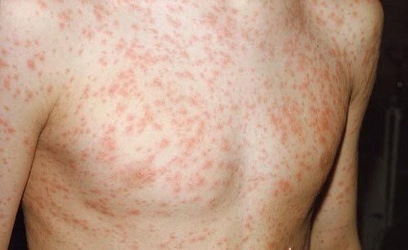 Điểm mặt 5 sai lầm khi điều trị bệnh Rubella bệnh nhân cần tránh - Ảnh 1.