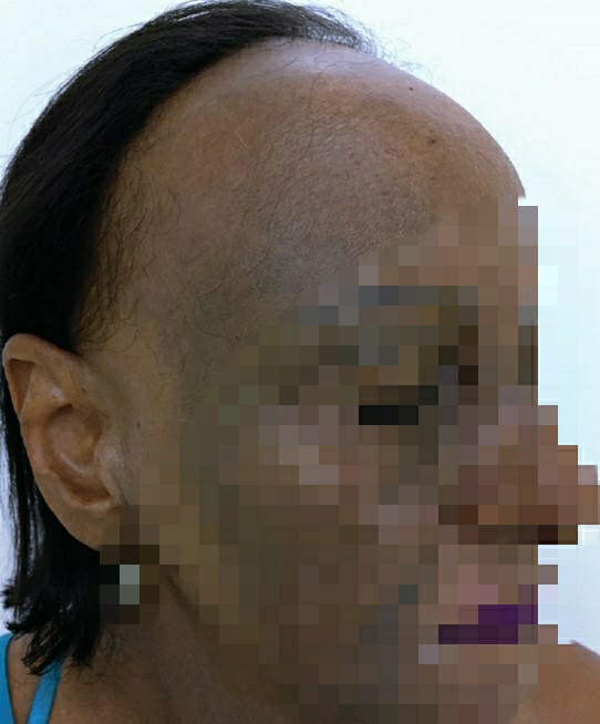 Nữ bệnh nhân mắc bệnh hiếm, rụng tóc cả nửa đầu - Ảnh 1.